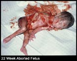 abortion picture 35